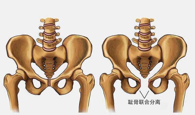 “耻骨越痛，分娩越容易”？关于耻骨痛的4个问题，孕妇要清楚