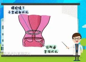 结合检查综合评估后，便决定给何女士实施腹腔镜子宫内口环扎术。